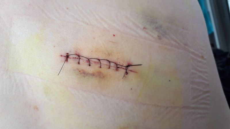 Sår efter fedtknude operation