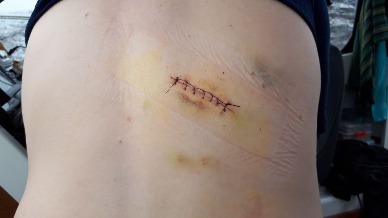 Sår efter fedtknude operation